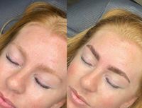 brow treatment3